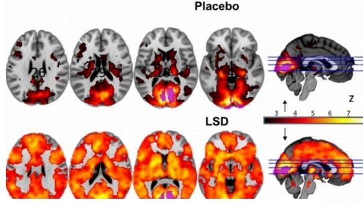 This image shows how, with eyes-closed, much more of the brain contributes to the visual experience under LSD than under a placebo. Photo: http://www3.imperial.ac.uk/