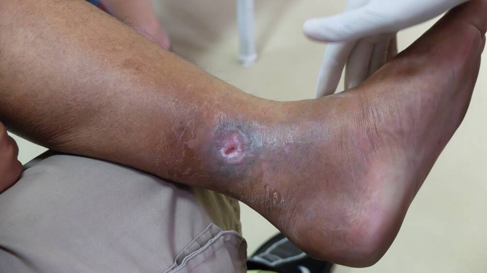 NEW HOPE: A Queensland researcher believes a new early warning tool can help treat debilitating venous leg ulcers.